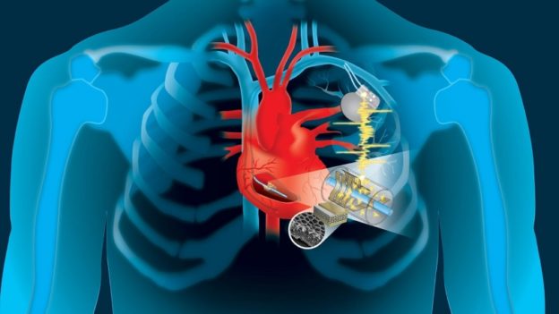 新型低侵入性「自供電」設備,為心律調節器供電